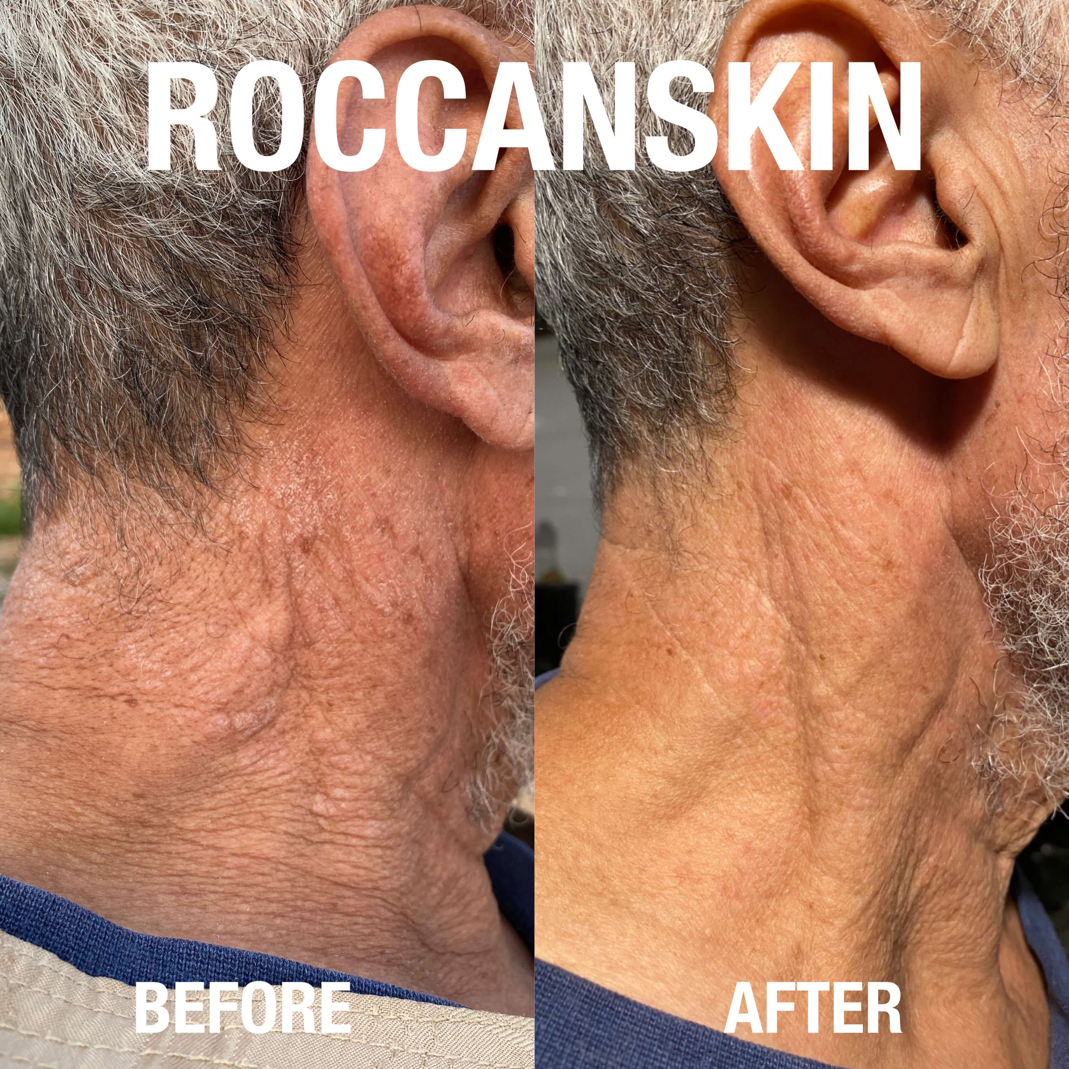 psoriasis before and after exfoliating with roccanskin exfoliating mitt.